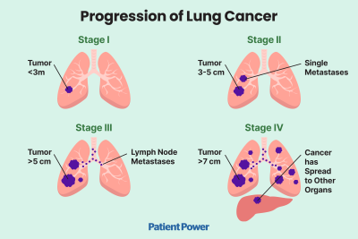 Understanding_Lung_Cancer_What_You_Need_to_Know