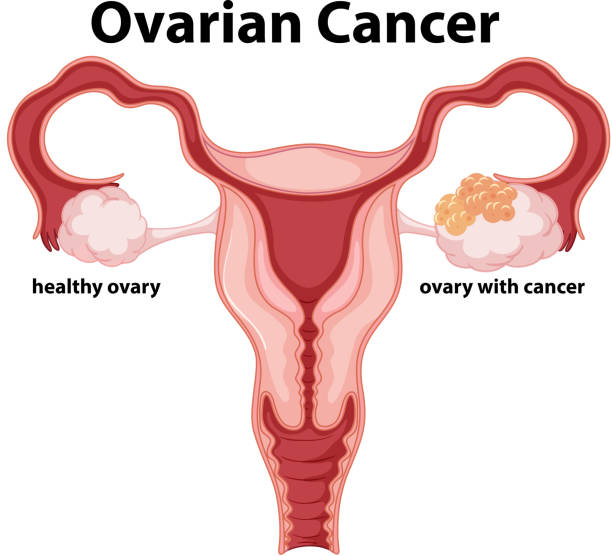 Ovarian Cancer Treatment in Mumbai
